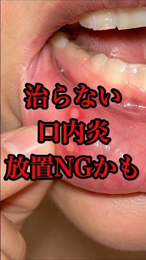 治らない口内炎、放置すると危ないかも