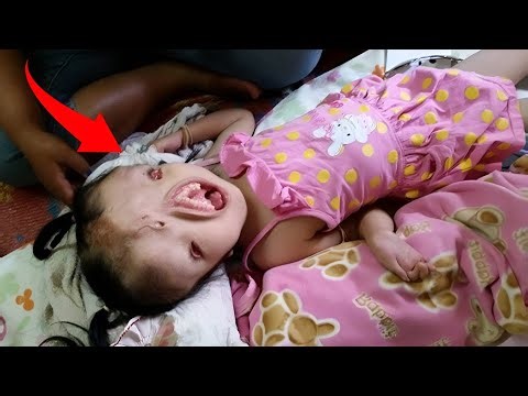 Incredible Young People From Around The World With Rarest Conditions