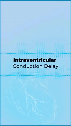 Intraventricular conduction delay (IVCD) is a critical ECG finding, marked by a widened QRS complex (≥120 ms), reflecting delayed electrical conduction within the ventricles. Left bundle branch block (LBBB) is characterized by a deep S wave in lead V1, broad, single-peaked R waves in lateral leads (I, aVL, V5-V6), and a delayed R wave peak time (>60 ms in V5-V6), indicating left ventricular conduction impairment. Conversely, right bundle branch block (RBBB) presents with a QRS duration exceeding