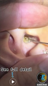 Interesting Earwax ASMR | The Most Satisfying Ear Cleaning for Massive Ear Blockages For A Girl