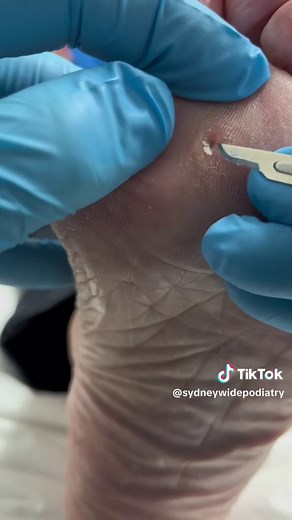 Another day and another painful corn being removed!! #fyp #foryou #viral #satisfying #pimple #podiatry #sydney #australia #foot #feet #corn #cornremoval #podiatrist #wart
