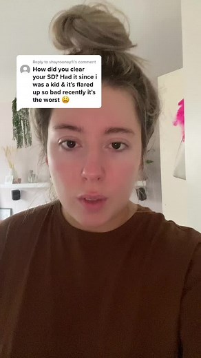 Reply to @shayrooney1 #seborrheicdermatitis #seborrheic #fyp #foryou #foryoupage #skinhealing #skin #skincare #skincareproducts #skincareroutine