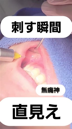 無痛神と呼ばれたい。痛覚を超える⁉️スピードで歯ぐきに刺さる麻酔針です。表面麻酔は使用しておりません #無痛#神の手と呼ばれたい#神業#カミワザ#達人ダイヤモンド今井院長神麻酔