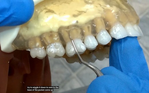 【搬运】Gracey龈下刮治器操作简单介绍