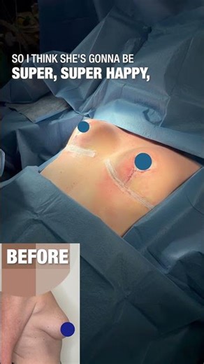 AMAZING 🌟 results following a breast reduction and lift. #beforeandafter