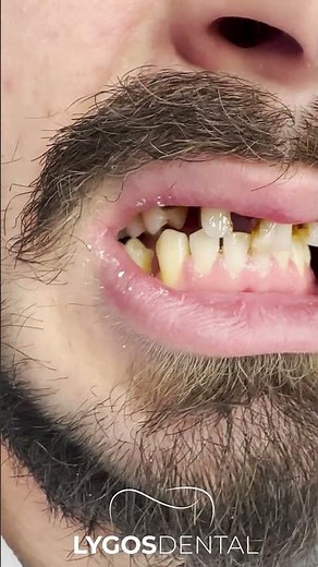 Dental Implants and Crowns: Before and After Transformation