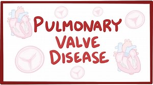 Pulmonary valve disease: Video, Causes, & Meaning | Osmosis