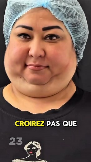Elle a subi une chirurgie pour enlever son double menton, mais attendez de voir sa mâchoire maintenant ! Regardez dans les commentaires 👇👇👇 | Histoires intéressantes