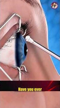 PRK Eye Surgery Step by Step Procedure Explained 2026 #shorts