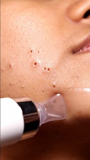 “Extreme Close-Up Blackhead Removal — So Satisfying!”