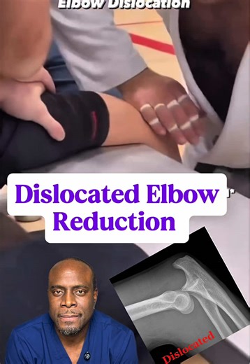 This is a clean elbow dislocation being realigned by a trained professional. It looks smooth, but behind the scenes there’s a lot to check, like nerve function, blood flow, and hidden fractures. Here’s why it’s not something to try at home. #JointHealth #InjuryRecovery #MedicalBreakdown #OrthopedicInsights #KnowYourBody Disclaimer: This video is for medical education purposes only. It does not replace professional medical care, diagnosis, or treatment. Please consult a licensed healthcare provid