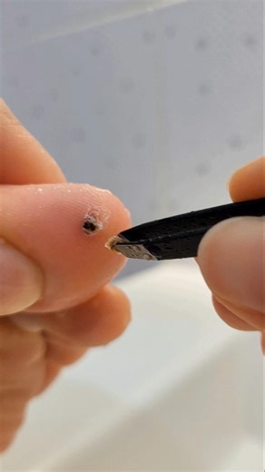 Foot Aftercare 🩹 Tweezing Excess Skin from Big Toe