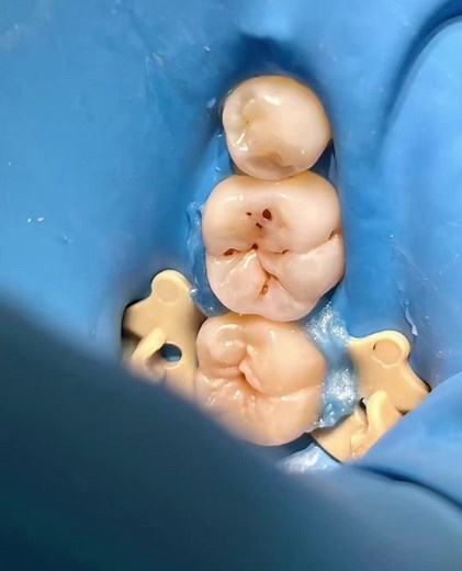 Dental Implant Procedure: Step-by-Step Guide