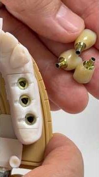 3 Mini-SYTON implant crowns that we just completed in my lab for Dr. Luciana Pavie in Massay