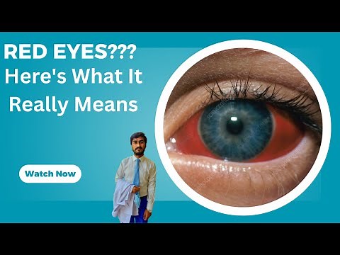 Red Eyes? Here's What It Really Means