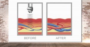 New treatment brings intimacy back without E.D. pills or invasive procedures