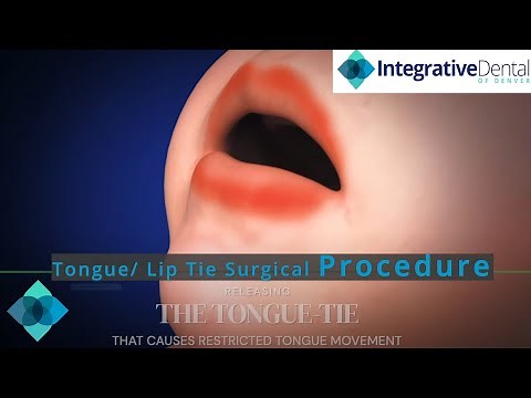 Tongue/ Lip Tie Surgical Procedure
