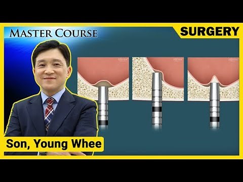 [Master Course Season2 - SURGERY] Sinus Floor Elevation - Crestal Approach(Osteotome)