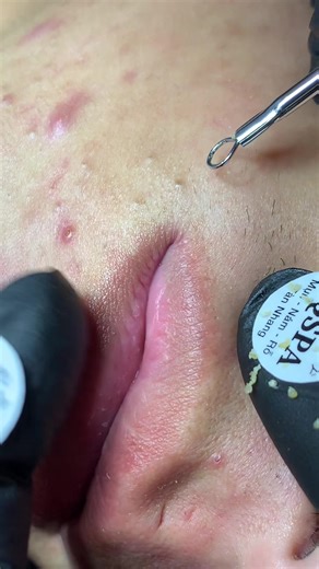 Ấp mụn #chamsocdamun#chamsocdaseo#chamsocdanam#tanbinh#Lqspa&academy | spa