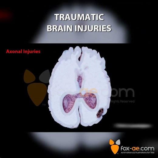 Traumatic Brain Injuries