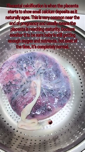 Placental calcification is when the placenta starts to show small calcium deposits as it naturally ages. This is very common near the end of pregnancy and usually means the placenta is reaching maturity. Doctors monitor it to be sure baby is still getting enough oxygen and nutrients—but most of the time, it’s completely normal. ❤️ #LIVEIncentiveProgram #educatoraward #LIVECareer #PaidPartnership
