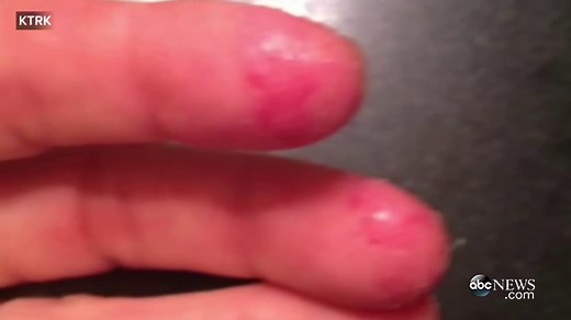 Preservative in Natural, Hypoallergenic Products Causing Allergic Reactions