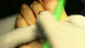 Weil Osteotomy and PIP Fusion for Claw Toe