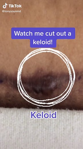Watch me cut out a keloid! #keloid #scar #surgery #operation #plasticsurgery #plasticsurgeon #steroids