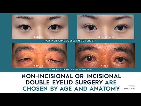 How Non-Incisional or Incisional Asian Double Eyelid Surgery are Chosen by Age and Anatomy