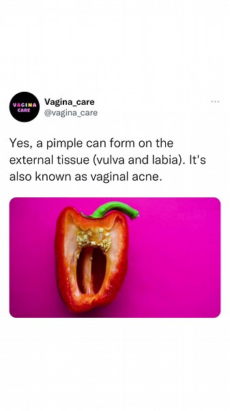Vagina pimple is common: The vaginal area has sweat glands and hair follicles that are prone to buildup, just like any other part of the body. Vagina pimples may be a thing bothering you but they are not major vagina problems. Some causes of vagina pimples include; Dermatitis: Contact dermatitis is a type of eczema caused by skin contact with an allergen or an irritant. Many cases of vaginal pimples are contact dermatitis in the genital area. these include products like vagina wash, vagina fragr