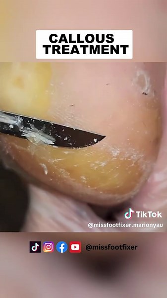 Professional Callous Treatment for Smoother Feet