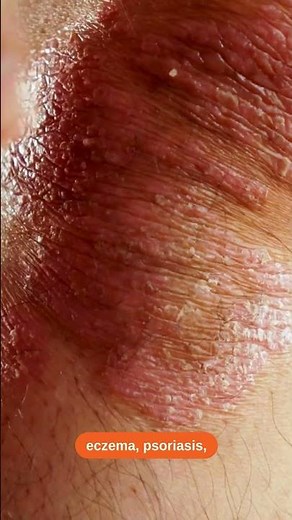 What is betamethasone used for? 💉 Uses, benefits, and precautions