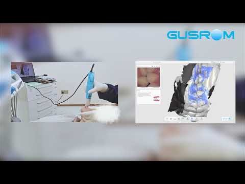 Real-Time Full Arch Scanning in Seconds | GScan IQ Intraoral Scanner Demo