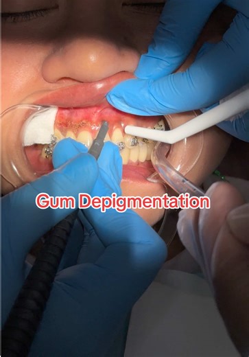 Dark gums? There’s a gentle solution. Gum depigmentation helps lighten gum color for a cleaner, more confident smile. Fast, safe and results you’ll notice right away. ✨ Your smile deserves this kind of glow. #AmpongDental #DarkGums #GumDepigmentation #GumCare #DentalClinic