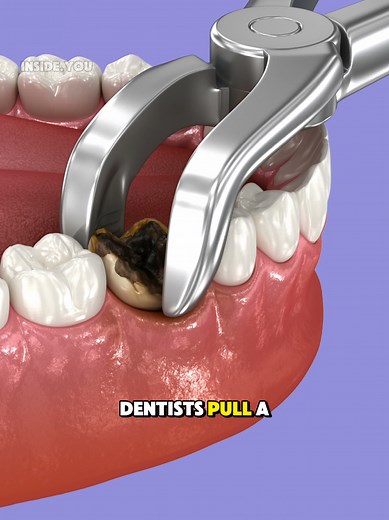 Tooth Extraction Procedure Explained Step-by-Step