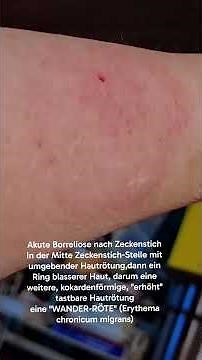 Lyme disease after a tick bite, typical "erythema migrans"! #pfotiundschwärzel #lymedisease #tick...