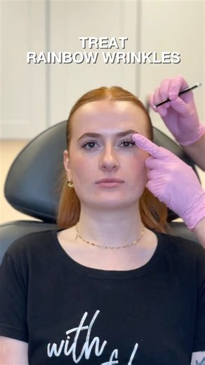 Rana FILLER & TOX EXPERT | EDUCATOR | CHICAGO on Instagram: "We often think of that mid-brow dimple as being caused only by the corrugator supercilii, but in reality, it’s also where fibers of the frontalis and orbicularis oculi interdigitate with the corrugator supercilii muscle. This dermal ‘dimple point’ is where these muscles converge, with a good old nudge from the orbicularis oculi pulling inward. Some choose not to treat this area because they worry it may drop the brow or, worse, increas