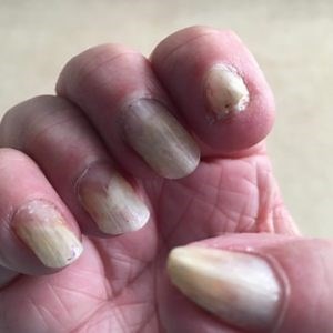 Onycholysis - NailKnowledge