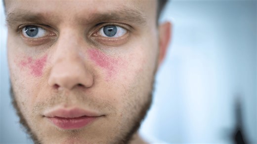 Nie tylko „kolorki” na twarzy. Ta choroba może atakować cały organizm