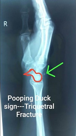 Triquetrum Bone fracture ...Pooping Duck Sign # Radiology