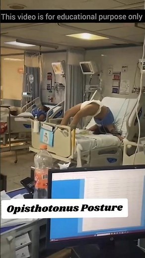 Opisthotonus Posture 😱 #factscience #scincefacts #shortvideos #mindcrush #shorts