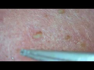 0252 keratin plug removal nose