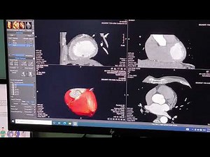 CT Angiogram #ctangiography #ctscan