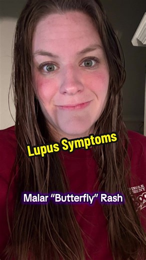 Recognizing Symptoms of Lupus: A Comprehensive Guide