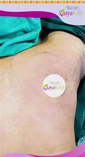 “Gynecomastia Surgery & Body Contouring in Kolkata | Kaayakalp Confidence Transformation”