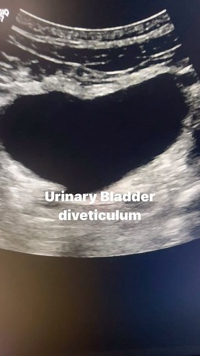 9.7K views · 279 reactions | Urinary bladder diverticulum #diverticulum #bladder #ultrasoundmadeeasy | Ultrasound made easy | Facebook