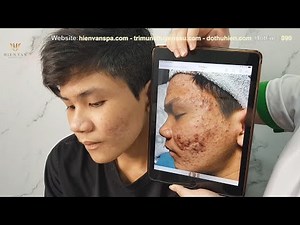 Review Clients about the results (Minh Khôi-Hoài Bão) at hien van spa-436