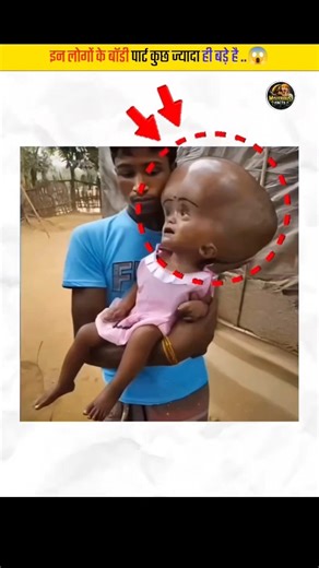 Why are these people's body parts so big? #bodyparts #amanzingfacts #viral #trending #shorts