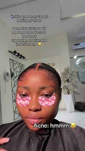 Understanding Acne Treatment for Hyperpigmentation