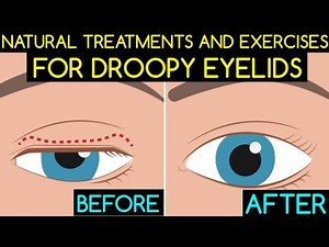 Natural Treatments and Exercises For Droopy Eyelids